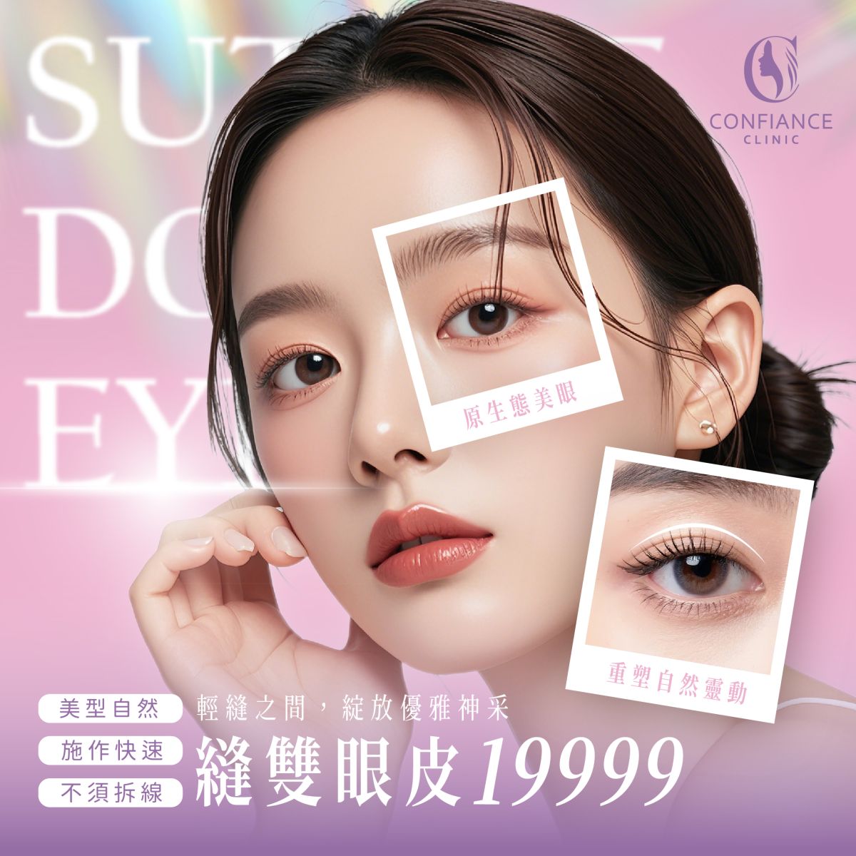 自由風 自然魅力雙眼皮手術